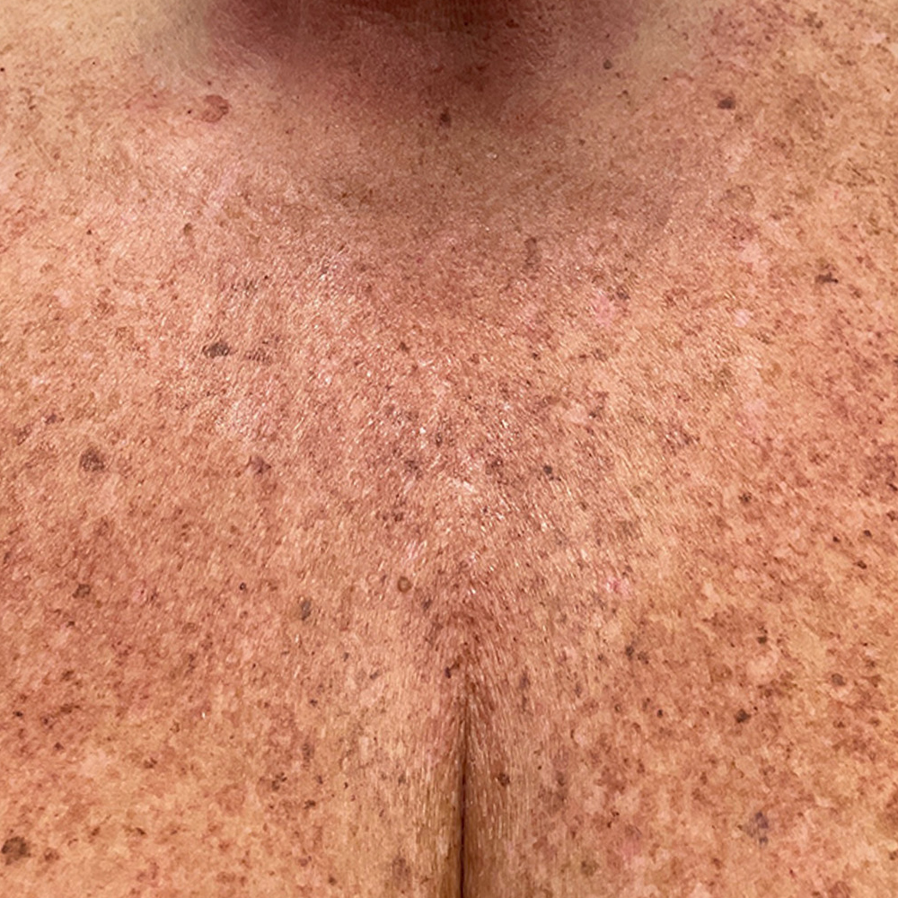 P6_AD_LP_Female_Chest-TM_0000_Lumecca Before