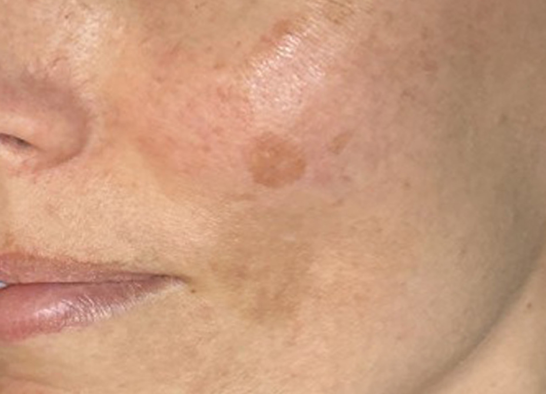 P1_EMA_Lumecca_Cheek_TM